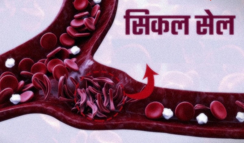 जशपुर : 18 जून को जिले के समस्त आयुष्मान आरोग्य मंदिरों में मनाया जाएगा विश्व सिकल सेल जागरूकता दिवस