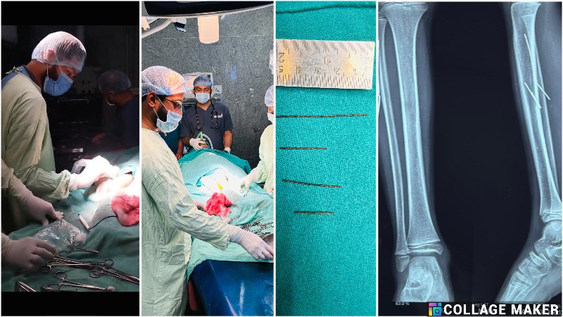 साइकिल हादसे के 4 महीने बाद सामने आया सच: सिम्स डॉक्टरों ने बालक के पैर से निकाले गहराई में धंसे लोहे के टुकड़े