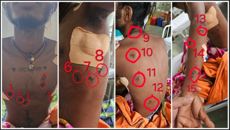 खून से लथपथ… फेफड़े फट चुके… सांसें थमने को थीं… 17 चाकू वार झेलने वाले युवक को सिम्स के डॉक्टरों ने मौत के मुंह से खींच लाया