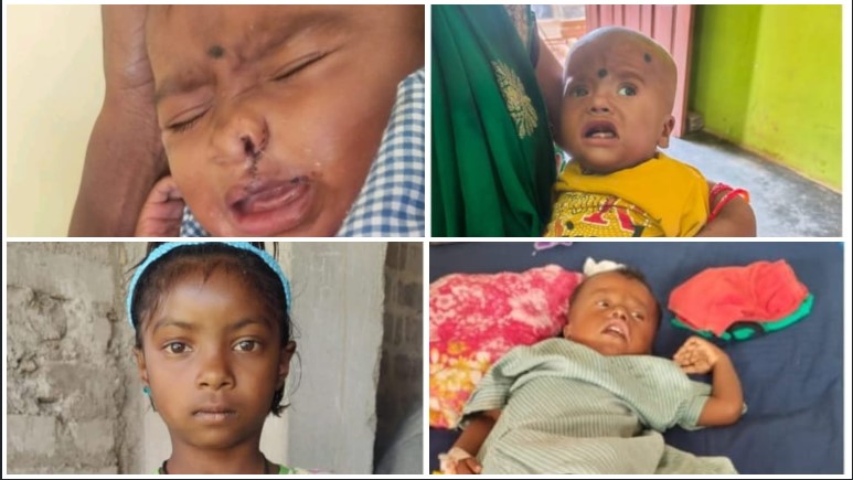 कलेक्टर रोहित व्यास के निर्देश पर चिरायु अभियान की बड़ी सफलता—जन्मजात हृदयरोग व तालू विकृति से पीड़ित तीन बच्चों को मिली नई जिंदगी, गरीब परिवारों के चेहरों पर लौटी मुस्कान