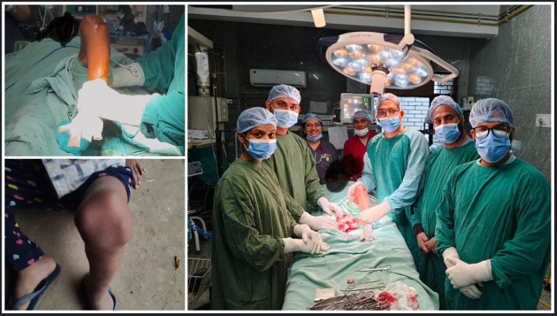 दुर्लभ जन्मजात बीमारी का सिम्स में सफल इलाज: आर्थोपेडिक विभाग ने 5 वर्षीय बच्चे को दी नई जिंदगी, अब जटिल बाल शल्य चिकित्सा के लिए नहीं जाना पड़ेगा बाहर