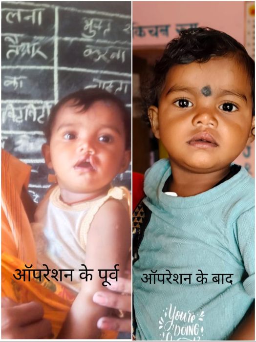 रायपुर में चिरायु योजना से बदली मासूम रंजना की जिंदगी: जन्मजात कलेफ्ट लिप का निःशुल्क ऑपरेशन, शासन ने उठाया पूरा खर्च, आर्थिक तंगी और भविष्य की चिंता हुई दूर