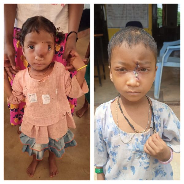 सुदूर वनांचल से ऑपरेशन थिएटर तक उम्मीद की यात्रा — चिरायु योजना के सहारे बस्तर की 6 वर्षीय अंजलि का सफल उपचार, आर्थिक तंगी के बावजूद शासन ने थामा हाथ