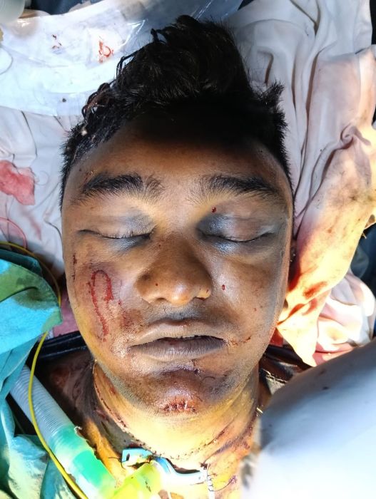 मौत से जंग जीतकर लौटा युवक: गले की कटी श्वासनली, गिरता ऑक्सीजन स्तर और सिर में गंभीर चोट के बीच सिम्स की विशेषज्ञ टीम ने आपातकालीन सर्जरी कर बचाई जान, चिकित्सा दक्षता का बना मिसाल