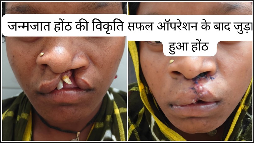 बीजापुर जिला अस्पताल की बड़ी सफलता: क्लेफ्ट लिप की सफल सर्जरी से 22 वर्षीय युवती का लौटा आत्मविश्वास, अब जी रही सामान्य जीवन