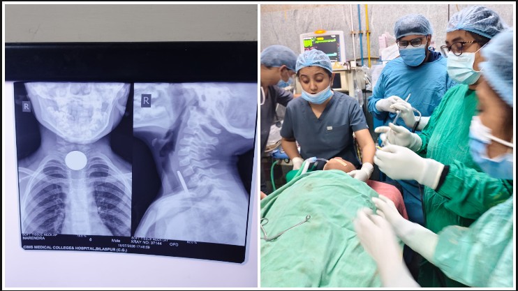 सिम्स बिलासपुर के डॉक्टरों ने रचा मेडिकल चमत्कार: 6 वर्षीय मासूम की आहार नली में फंसा सिक्का सफल ऑपरेशन से निकाला, समय रहते बचाई मासूम की जान