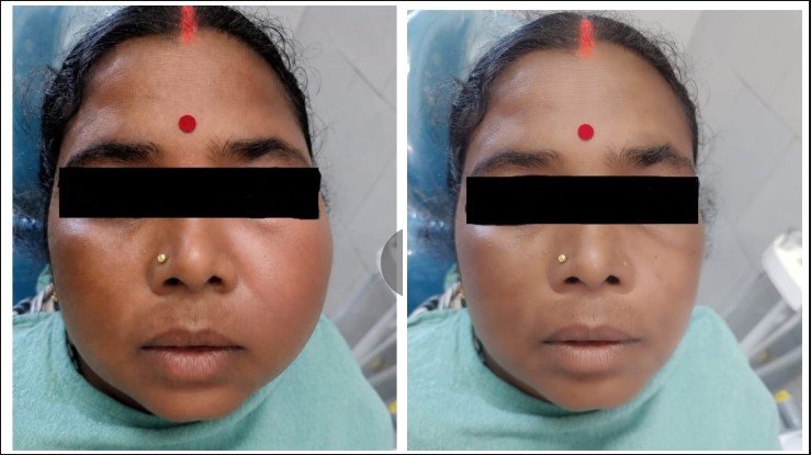 दांत के दर्द को नजरअंदाज करना पड़ा भारी! 38 वर्षीय महिला के जबड़े में बन गई बड़ी सिस्ट, सिम्स में जटिल ऑपरेशन से मिली नई राहत