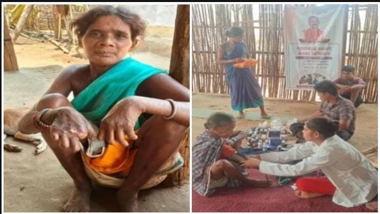 जहां पहुंचना भी किसी चुनौती से कम नहीं, वहां स्वास्थ्य दल ने जगाई जिंदगी की नई उम्मीद! सात बार नदी पार कर तुमेरादी पहुंचे कर्मियों ने खोजा कुष्ठ रोग का मामला, समय पर इलाज से टला स्थायी दिव्यांगता का खतरा—जानिए सन्नो बाई की संघर्ष और सेवा की कहानी!